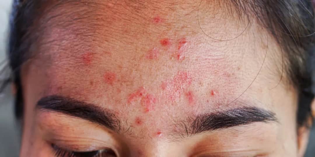 Pryszcze na pośladkach to nie trądzik! Jak się ich pozbyć?