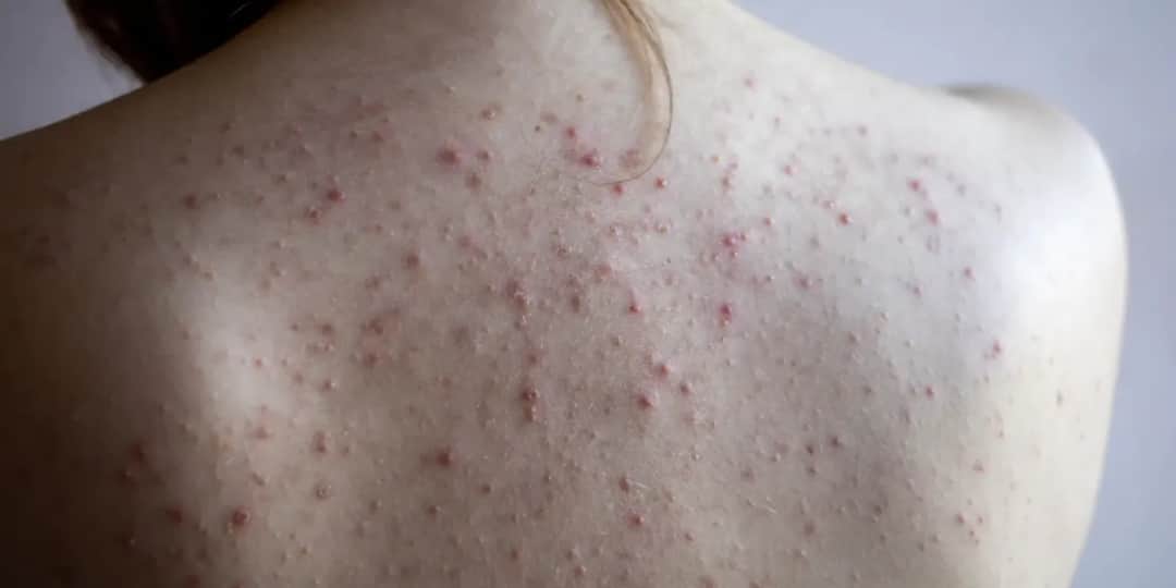 Pryszcze na plecach? Skuteczne sposoby i gładka skóra przewodnik