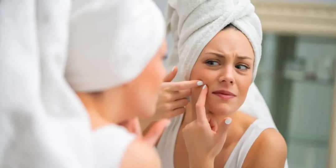 Jak wycisnąć pryszcza bezpiecznie? Poznaj ryzyka i alternatywy!