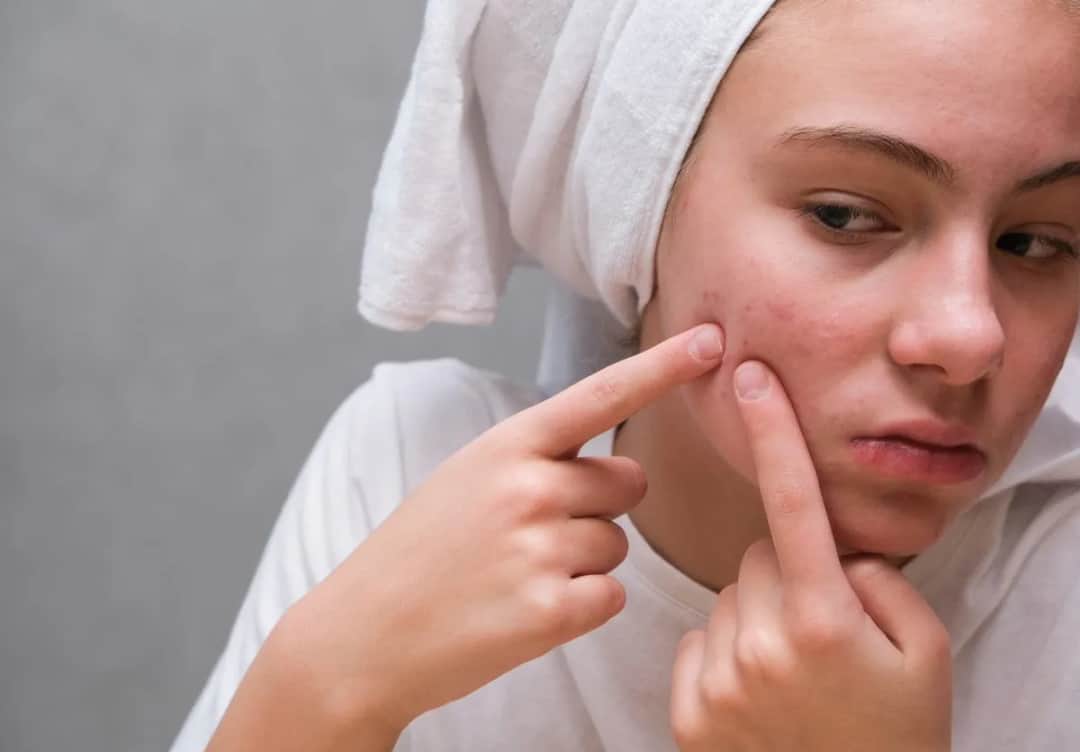 Pryszcz przed ważnym wyjściem? Pozbądź się go w kilka godzin!