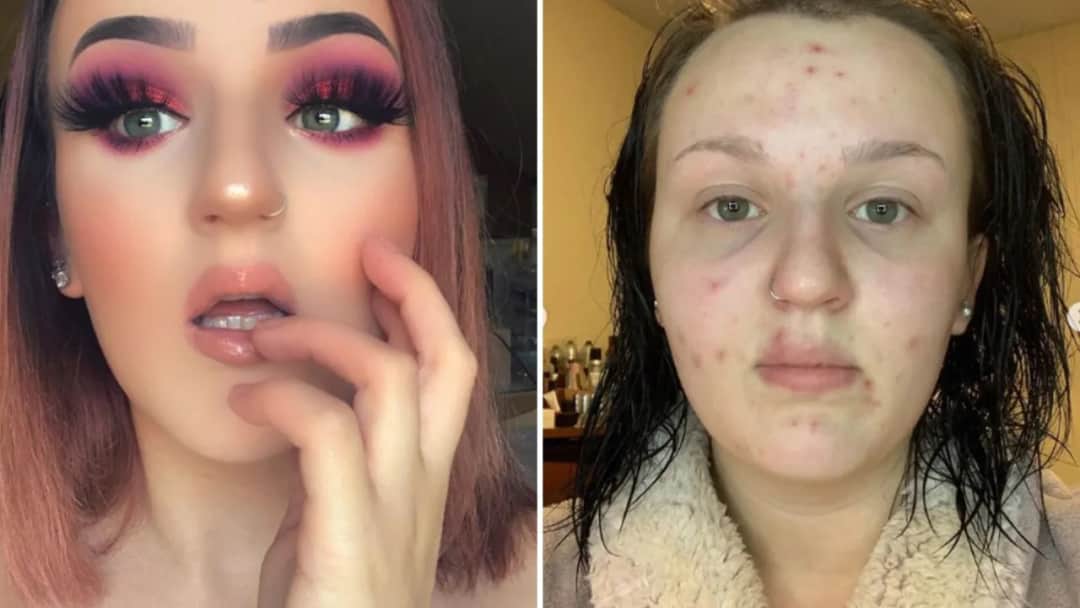 Jak ukryć pryszcze bez makijażu? Szybkie triki i plan awaryjny