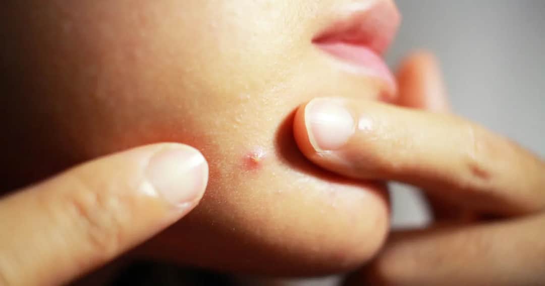 Pryszcz pod skórą? Nie wyciskaj! Sprawdzone metody na szybką ulgę